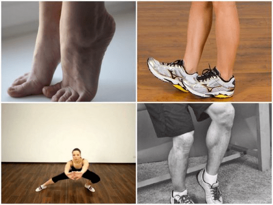 Varisli damarlar bacak ağrısına neden olur