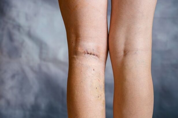 Varis ameliyatı sonrası bacakta dikiş