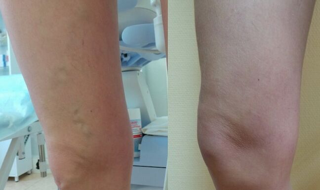 Retiküler varis tedavisi öncesi ve sonrası bacak