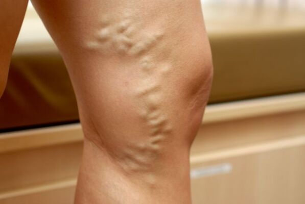 Pelvisin varisli damarları olan bacaktaki varisli damarlar