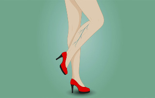Bir kadının bacaklarındaki varisli damarlar